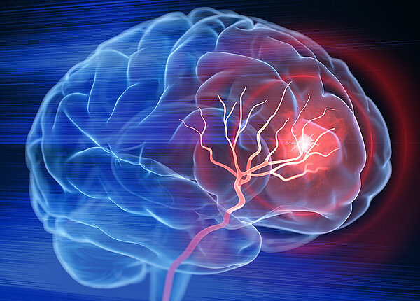 Neuropsychologische Folgen nach einem Schlaganfall Nahaufnahme eines Gehirns, indem ein Schlaganfall zu sehen ist.