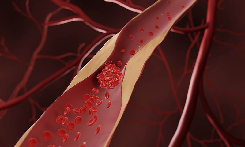 Verengte Stelle in einem Butgefäß, in der sich gerade ein Thrombus bildet