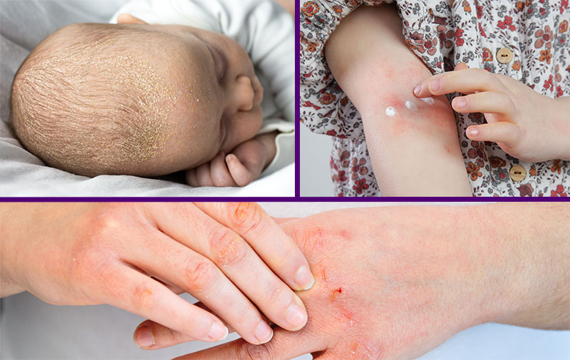 Collage: Ein Baby mit Milchschorf, ein junges Mädchen, das sich ihre Neurodermitis an der Ellenbeuge eincremt, eine Erwachsene mit rissigen Händen.