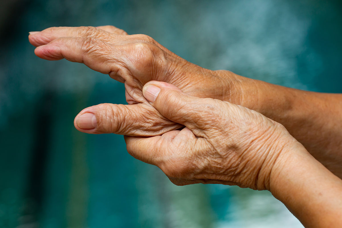 Die Hände einer alten Frau: Die Knöchel sind verdickt und die Finger knicken seitlich weg.