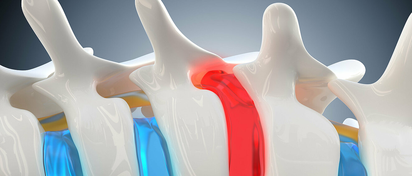 Queransicht einer Wirbelsäule und die Gallertmasse der Bandscheiben ist in rot und blau dargestellt.
