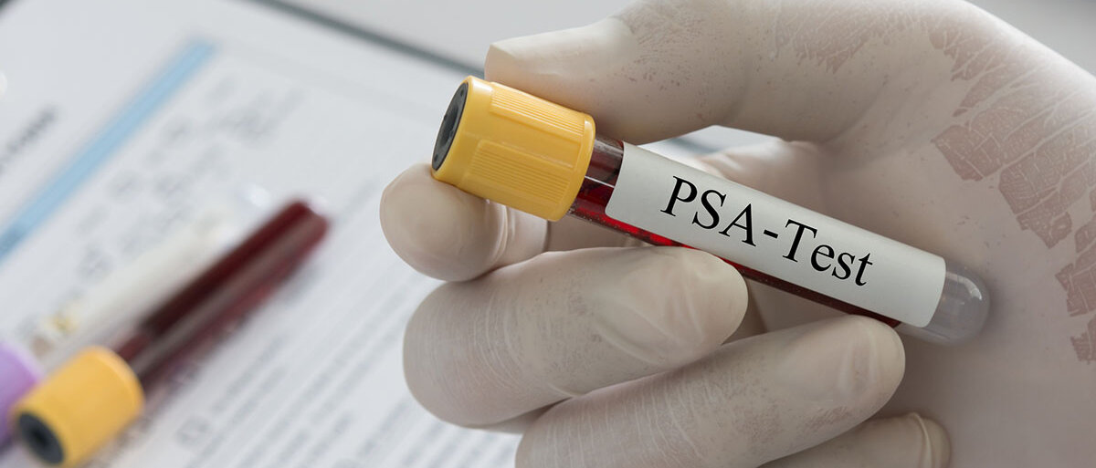 Arzt hält Probenblutentnahmeröhrchen mit PSA-Test-Etikett in der Hand.