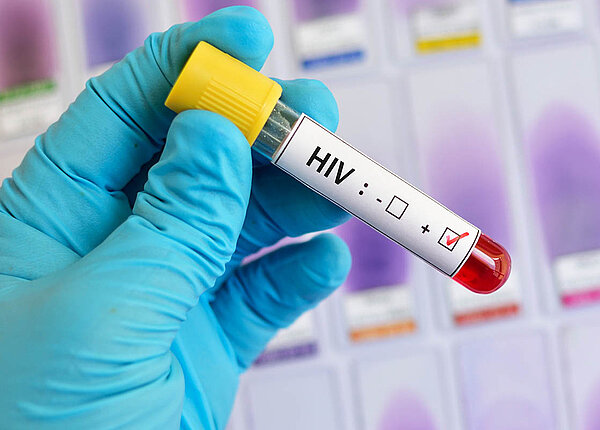 HIV-Medikamente können die Infektion nicht heilen, aber Aids unterdrĂŒcken. HIV-positive Blutprobe