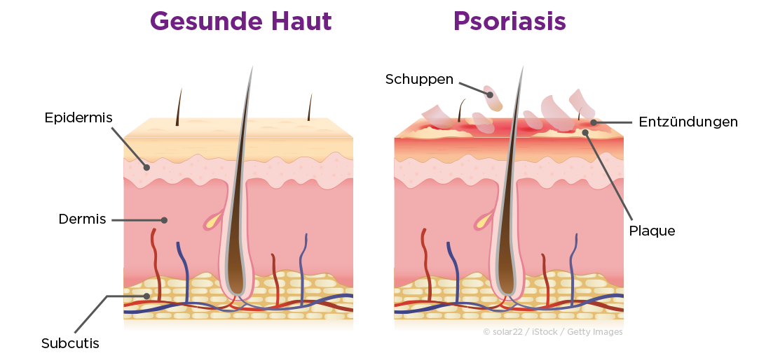 Abbildung einer gesunden Haut und einer Psoriasis. Haarwurzel ragt aus den Ebenen hervor. Veränderungen werden deutlich gemacht.