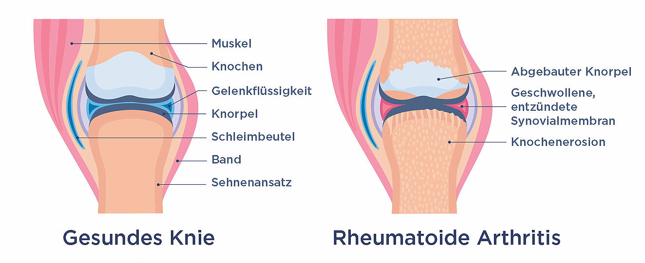 Anatomische Zeichnung eines gesunden Knies und eines mit rheumatoider Arthritis im Vergleich