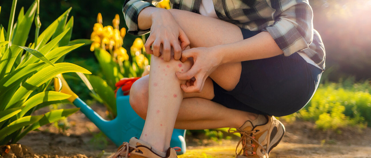 Nahaufnahme von den zerstochenen Beinen einer Frau, die im Garten kniet, und sich an den Mückenstichen kratzt.