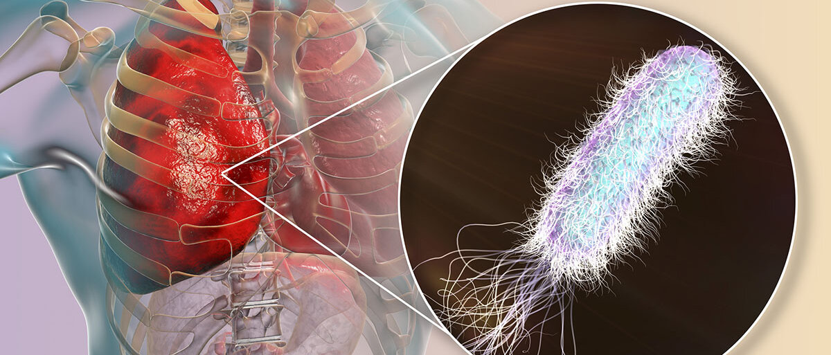 3D-Darstellung von Lungeninfektion durch Pseudomonas aeruginosa