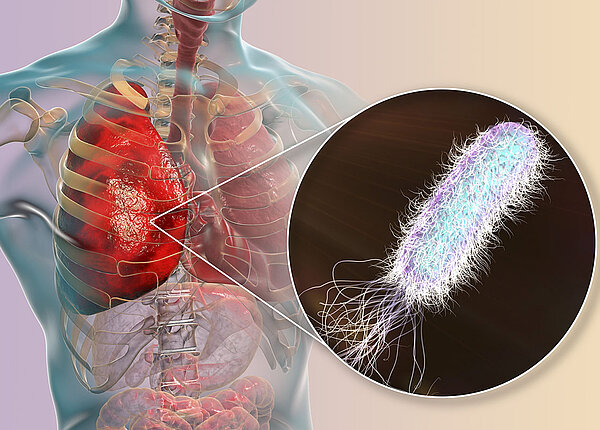 3D-Darstellung von Lungeninfektion durch Pseudomonas aeruginosa
