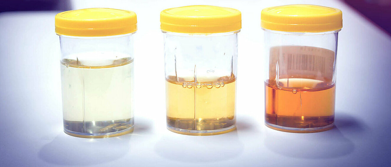 Drei Schraubbecher mit Urinproben nebeneinander: Die Linke Probe ist bernsteinfarben und leicht trüb, die mittlere ist gelb und klar, die rechte klar und fast farblos.