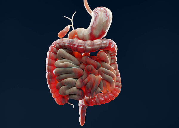 3D-Darstellung der Organe des Verdauungstrakts von der Speiseröhre bis zum Enddarm, wobei in allen Bereichen Entzündungen rot markiert sind.