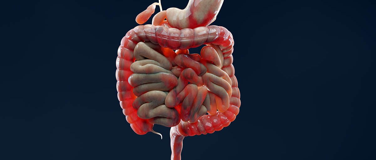 3D-Darstellung der Organe des Verdauungstrakts von der Speiseröhre bis zum Enddarm, wobei in allen Bereichen Entzündungen rot markiert sind.