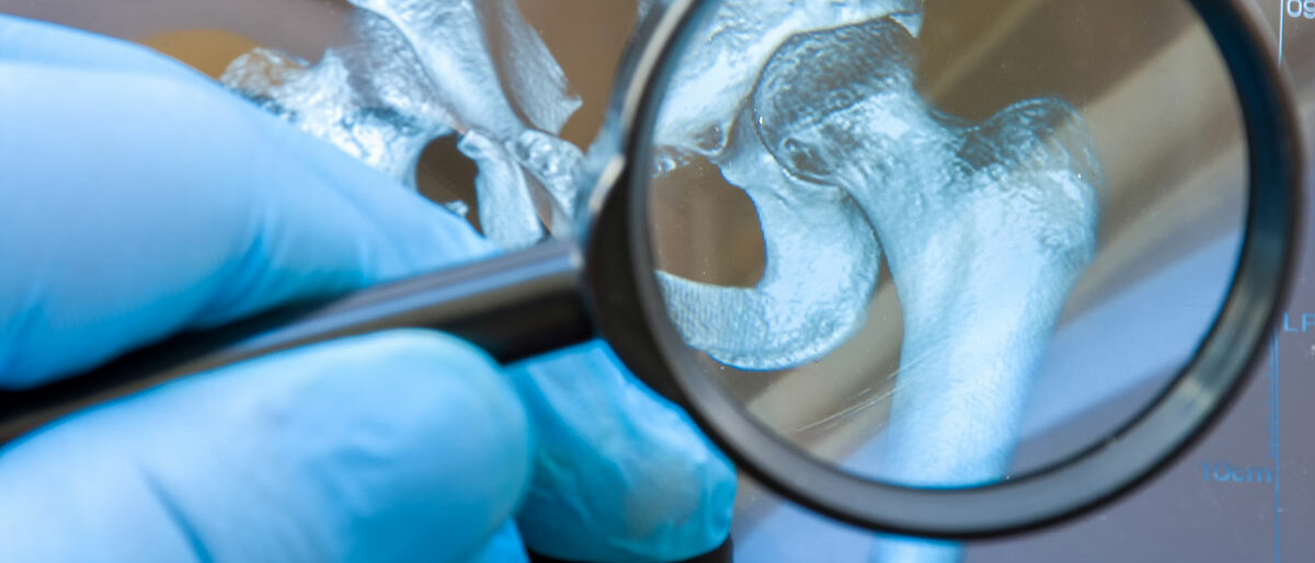 Arzt hält mit Lupe auf MRT-Aufnahme eines Hüftknochens