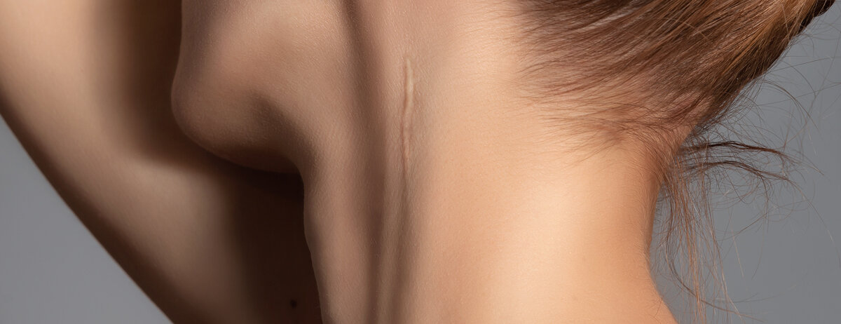 Eine Frau hat seitlich am Hals eine lange, dünne Narbe.