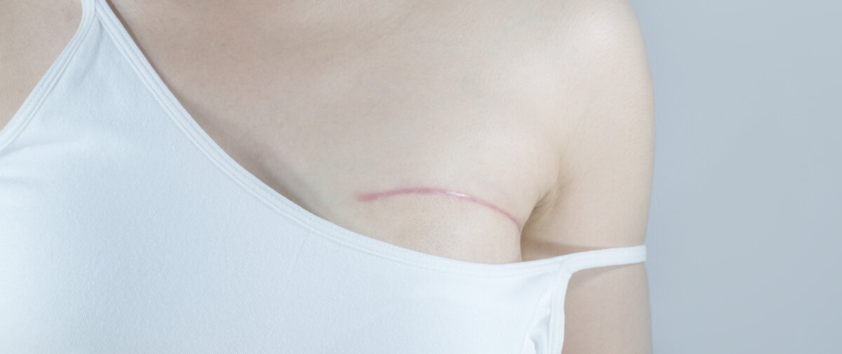 Die Operationsnarbe nach einer Mastektomie ist bei einer Frau sichtbar, da der Träger ihres Oberteils verrutscht ist.